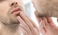 علائم و راه‌های درمان تبخال چیست؟