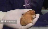 سنگ ۱۶ سانتیمتری از کلیه یک بیمار خارج شد