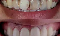 هزینه ترمیم کامپوزیت دندان چقدر است؟