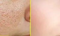 بهترین کرم برای بستن منافذ باز پوست صورت کدام است؟ 