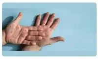 نظر کارشناسان آمریکایی درباره شیوع «آبله میمونی»