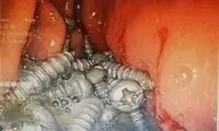 خارج کردن ۴۷ پیچ از معده یک بیمار در کرج!