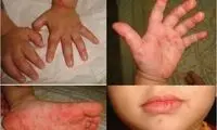 شیوع آبله میمونی در مدارس صحت دارد؟
