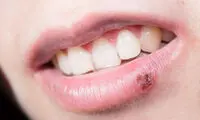 چرا تبخال با استرس تشدید می‌شود؟