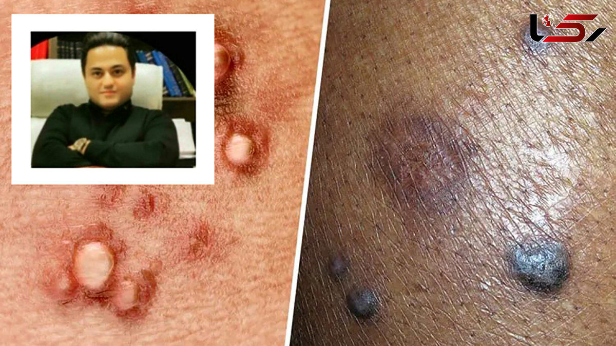 کشف داروی شگفت‌انگیز HPV توسط دانشمند ایرانی