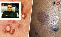 کشف داروی شگفت‌انگیز HPV توسط دانشمند ایرانی
