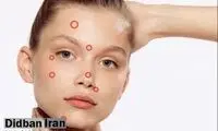جوش‌های هر نقطه از صورت نشانگر چه بیماری هستند؟