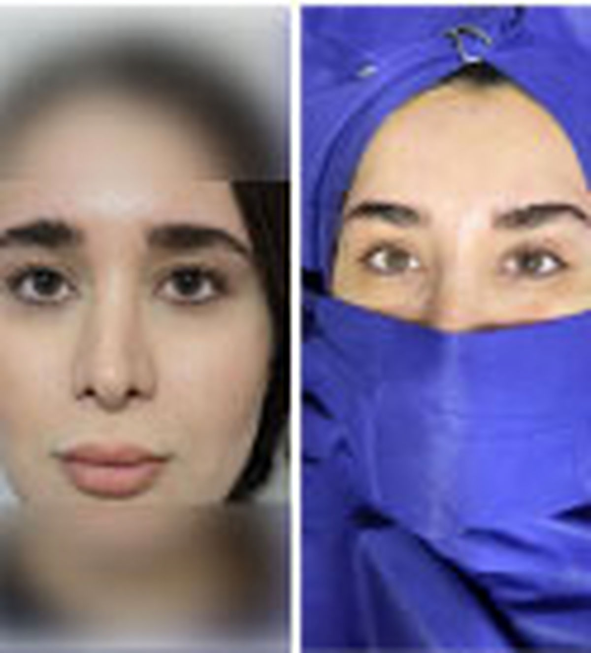   هزینه لیفت اندوسکوپی ابرو در سال ۱۴۰۴ چقدر است؟ 