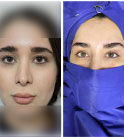 هزینه لیفت اندوسکوپی ابرو در سال 1404 چقدر است؟