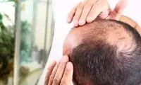 درمان طاسی به طور تصادفی کشف شد