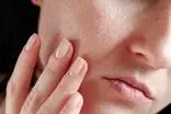 ۱۱ روش مؤثر برای از بین بردن جای جوش