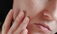۱۱ روش مؤثر برای از بین بردن جای جوش