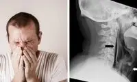 سوراخ شدن گلو بر اثر نگهداشتن عطسه