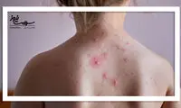آبله مرغان تا چند روز واگیر دارد؟