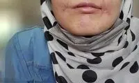 مرد مشهدی لب‌های زن ۱۸ ساله‌اش را دوخت