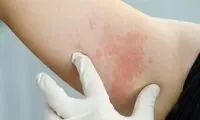 با کهیر گرمایی آشنا شوید