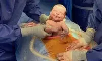 علت افزایش آمار سزارین در برخی استان‌ها