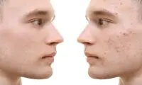 نکاتی که باید درباره جوش‌های صورت بدانید