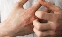 چطور بفهمیم سیستم ایمنی بدن ما ضعیف است یا قوی؟