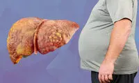 یک داروی ضد چاقی علیه کبد چرب