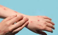 راهکار احتمالی پیشگیری از ابتلا به آبله میمون