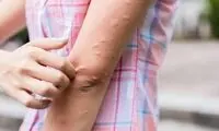 دلایل به وجود آمدن کهیر بر روی پوست چیست؟