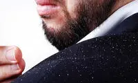 روش‌های خانگی درمان شوره سر 