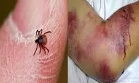این بیماری خطرناک جان یک ایرانی را گرفت