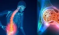 علل پوکی استخوان و راه‌های پیشگیری از آن