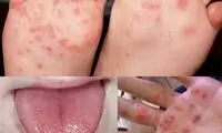 چگونه به بیماری HFMD مبتلا می‌شویم؟