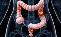 چه کسانی در معرض خطر ابتلا به سرطان روده هستند؟