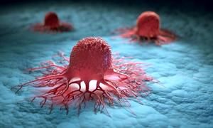 علائم هشداردهنده سرطان برای مردان