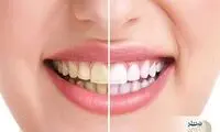 ۷ روش طبیعی برای برق زدن دندان
