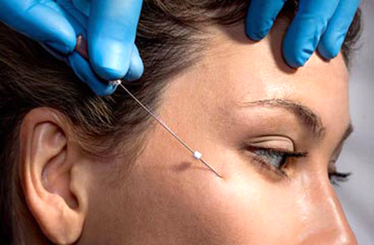 کانتورینگ صورت با تزریق ژل چگونه انجام میشود؟