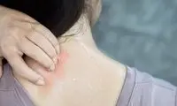 نکات طلایی برای پیشگیری و درمان عرق‌سوز شدن