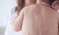 هشدار شیوع آبله‌مرغان در فصل بهار