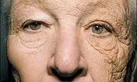 تصویری تکان دهنده از اثر نور آفتاب روی صورت