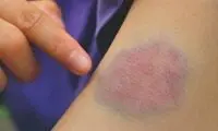 کبودی خارش‌دار؛ از دلایل تا درمان