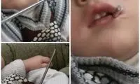فرو رفتن میله در دهان کودک ۲ ساله