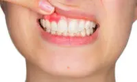 علل خونریزی لثه هنگام مسواک زدن