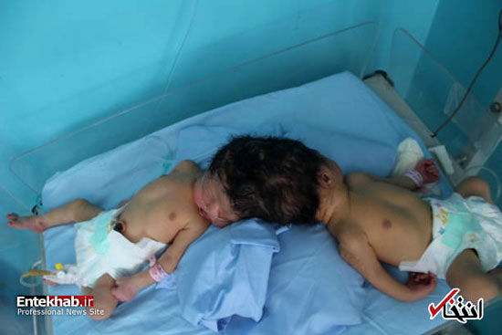 تولد دوقلو‌های به‌ هم چسبیده در افغانستان
