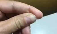 هشدار جدی پزشکان درباره ژل ناخن به خانم‌ها