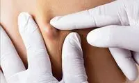 بهترین پزشک کیست مویی در تهران کیست؟معرفی 4 پزشک برتر برای درمان کیست مویی