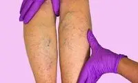 روش‌های مقابله با عوارض سیاهرگ‌های واریسی