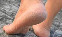 ترک پاهایتان را در خانه درمان کنید