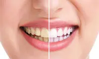 روش های سفید کردن دندان ها