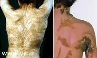 عجیب ترین بیماری های پوستی +عکس