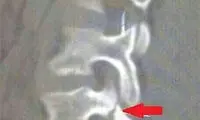 تصویر تکان دهنده از شکستگی کمر نیمار