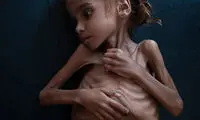 دختر بچه یمنی بالاخره از گرسنگی جان باخت