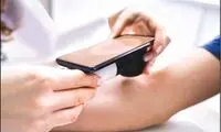 تشخیص سرطان پوست با هوش مصنوعی